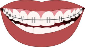 dientes con ortodoncia
